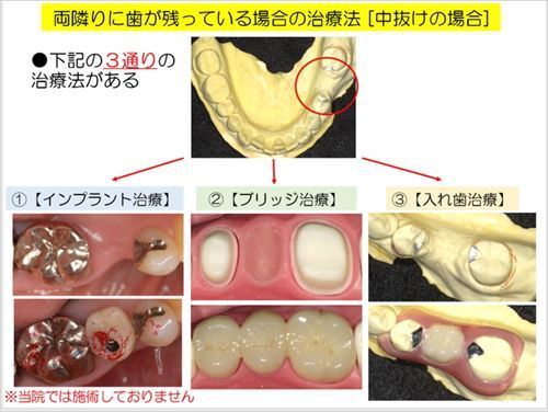 中抜けの治療法_R.jpg