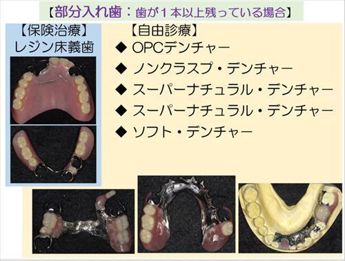 部分入れ歯 種類_R.jpg