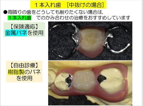 １本入れ歯_R.jpg